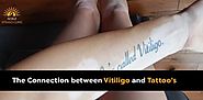 The Connection between Vitiligo and Tattoo’s