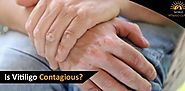 Does Vitiligo Spread From One Person To Another?