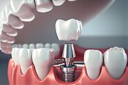 How to Maintain Your Dental Implants in Richmond for Longevity