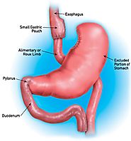 Roux-en-Y Gastric Bypass Surgery Clinic in Perth, Australia