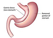 Consult Dr Ravi Rao for Vertical Sleeve Gastrectomy surgery