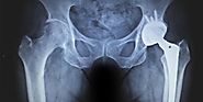 When Should You Opt For A Hip Replacement Surgery?