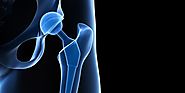 Is It Fruitful To Get An Anterior Hip Replacement Done?