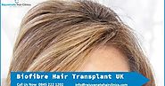 Provide Best Biofibre Hair transplant In UK