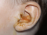 How To Get Rid Of Ear Infection Fast - Best Home Remedies