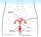 Ovarian Cysts