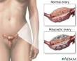 Ovarian cyst - Symptoms