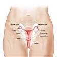 Ovarian Cancer Stage 3 Symptoms