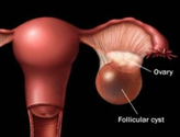 Ovarian Cyst Symptoms Signs