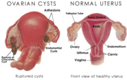 Symptoms Ovarian Cyst Rupture