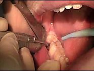 Impacted Wisdom Teeth Removal | Wisdom Tooth Damage Treatment