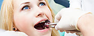 All Basic Things You Should Know About Wisdom Teeth Removal