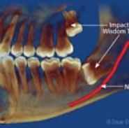 Impacted Wisdom Tooth — Rare Effects