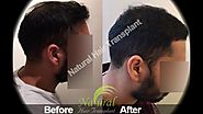 Hair Transplant in Delhi - Patient's results after 7 months