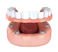 How Houston Dental Implants Can Be Used for Denture Stabilization