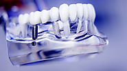 Gain More Confidence and Restore Your Smile With Dental Implants