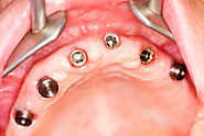 When You Should Consider Full Mouth Dental Implants Instead of Dentures