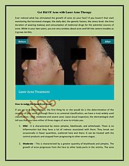 Get Rid Of Acne with Laser Acne Therapy!