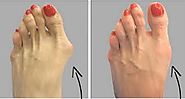 How to Get Rid of Bunions Completely Naturally - By Dr. Praveen Chaudhary | Lybrate