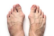 How to get rid of bunions without surgery ? - Charlies Magazines