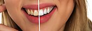 Myth: You can’t whiten your teeth if you have sensitivity