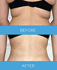 The Beautiful And Wonderful Way of Fat Reduction With Vaser Liposuction