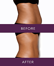 Fat Reduction with Vaser Liposuction