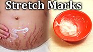Natural Remedies to Remove Pregnancy Stretch Marks - Health Trends