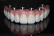 Dental Implants All on 4 (Four)| All on 4 Dental Implants Cost - Estetica Dental Lab, London, UK