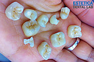 EMAX Crowns | EMAX Dental | EMAX Crowns Cost - Estetica Cosmetic Dental Laboratory London