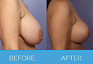 Know more about Breast Uplift Surgery or Mestopexy
