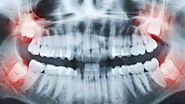 Website at http://wisdomteethdentist.over-blog.com/what-is-impacted-wisdom-teeth-and-how-is-it-treated.html