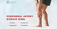 Peripheral Arterial Disease (PAD): Symptoms, Causes, Diagnosis, Treatment