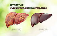 Stem Cell Therapy - A Hope for Liver Transplants Patients