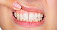How to Know If You Have Gum Disease and What to Do About It