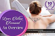 Things To Consider Before Treating Your Tattoos With Laser