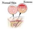 Natural Eczema Treatment