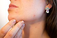 Medical Spa: Choosing the Right Chemical Peel to Solve Your Acne Problems