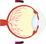 Ever Wondered What’s A Cataract?
