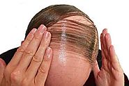 Motifs de perte de cheveux masculins, Greffe Cheveux Femme Turquie, Transplantation de cheveux, Aperçu de la Perte de...