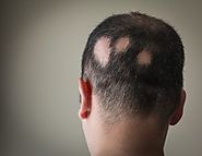 Alopécie, Modèle de perte de cheveux féminin , Chute de cheveux chez le femmes