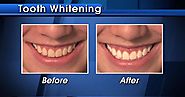 Sarasota Tooth Whitening Specialists