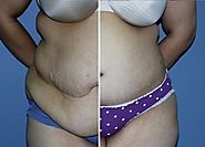 The Tummy Tuck - Fort Lauderdale FL - eSSe Plastic Surgery