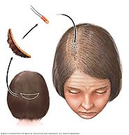 Hair loss - Diagnosis and treatment - Mayo Clinic