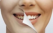 Tooth Whitening | Tooth Lightening | Upper & Lower Teeth | NZ