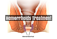 Home Remedies For Hemorrhoids | Hemorrhoids treatment