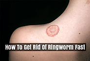 How To Get Rid Of Ringworm Fast - Ringworm treatment