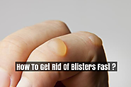 Best 8 Way To Get Rid of Blisters Fast - Blisters Treatment