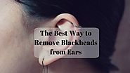 8 Natural Remedies To Get Rid Of Blackheads From Ears
