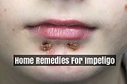 Treatment For Impetigo Infection In Children And Adults